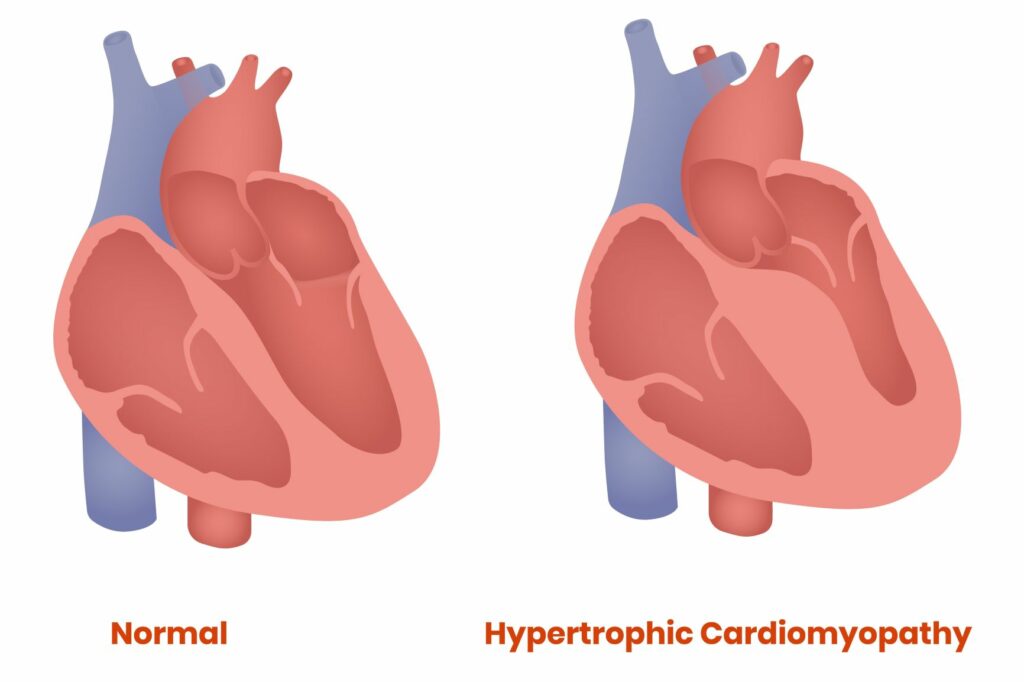 Grafik eines Herzens bei HCM