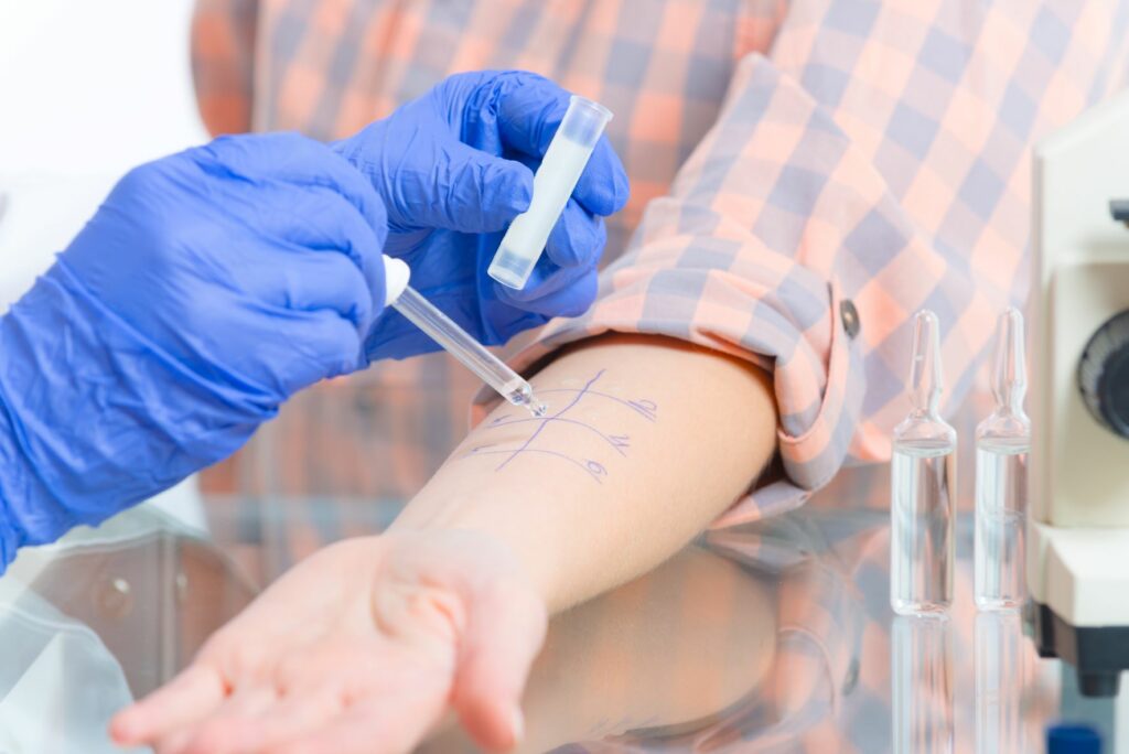 Arzt führt einen Prick-Test auf Allergien durch Prick-Test zur Erkennung einer Katzenallergie